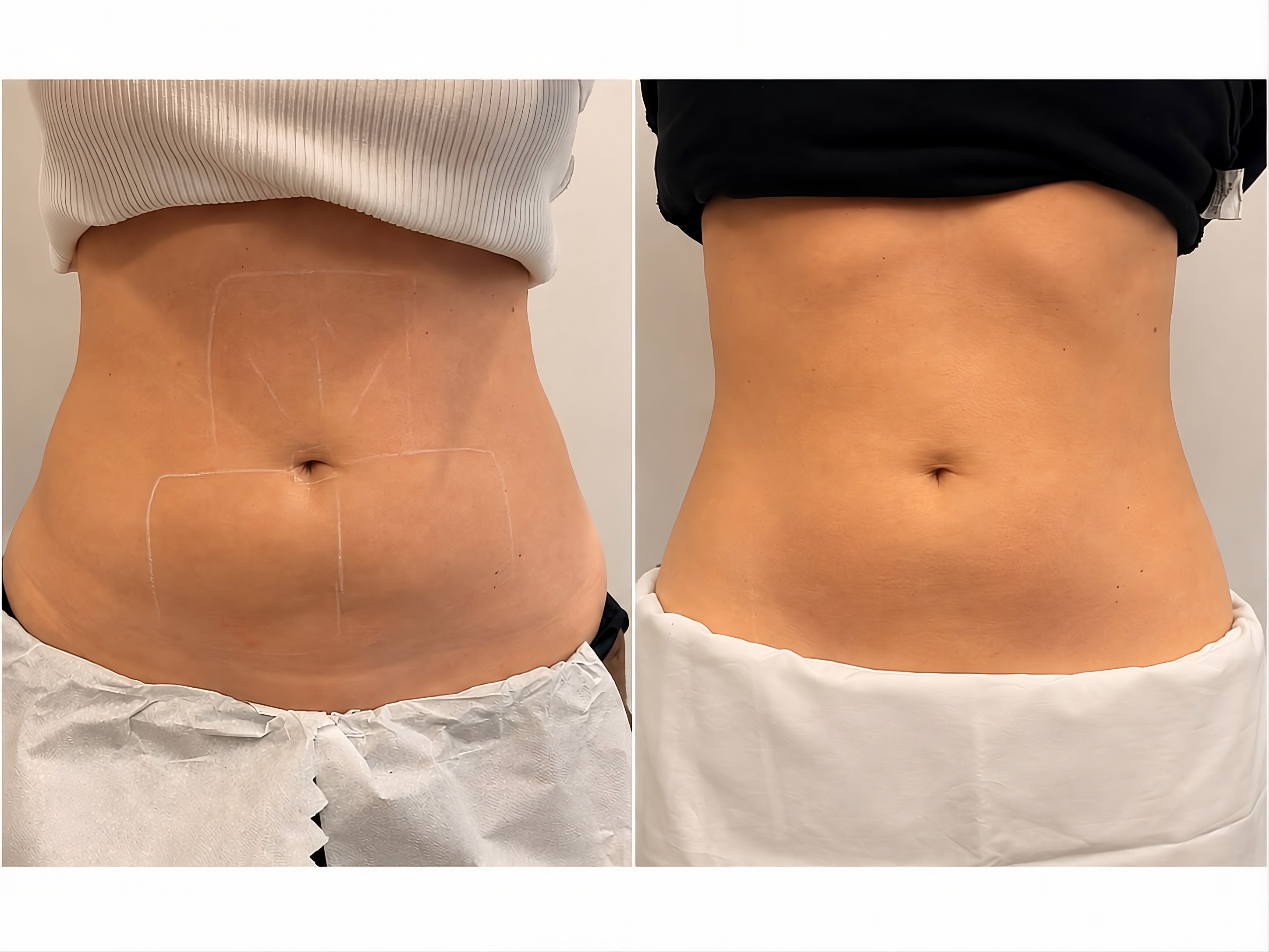 Antes e depois — abdômen
