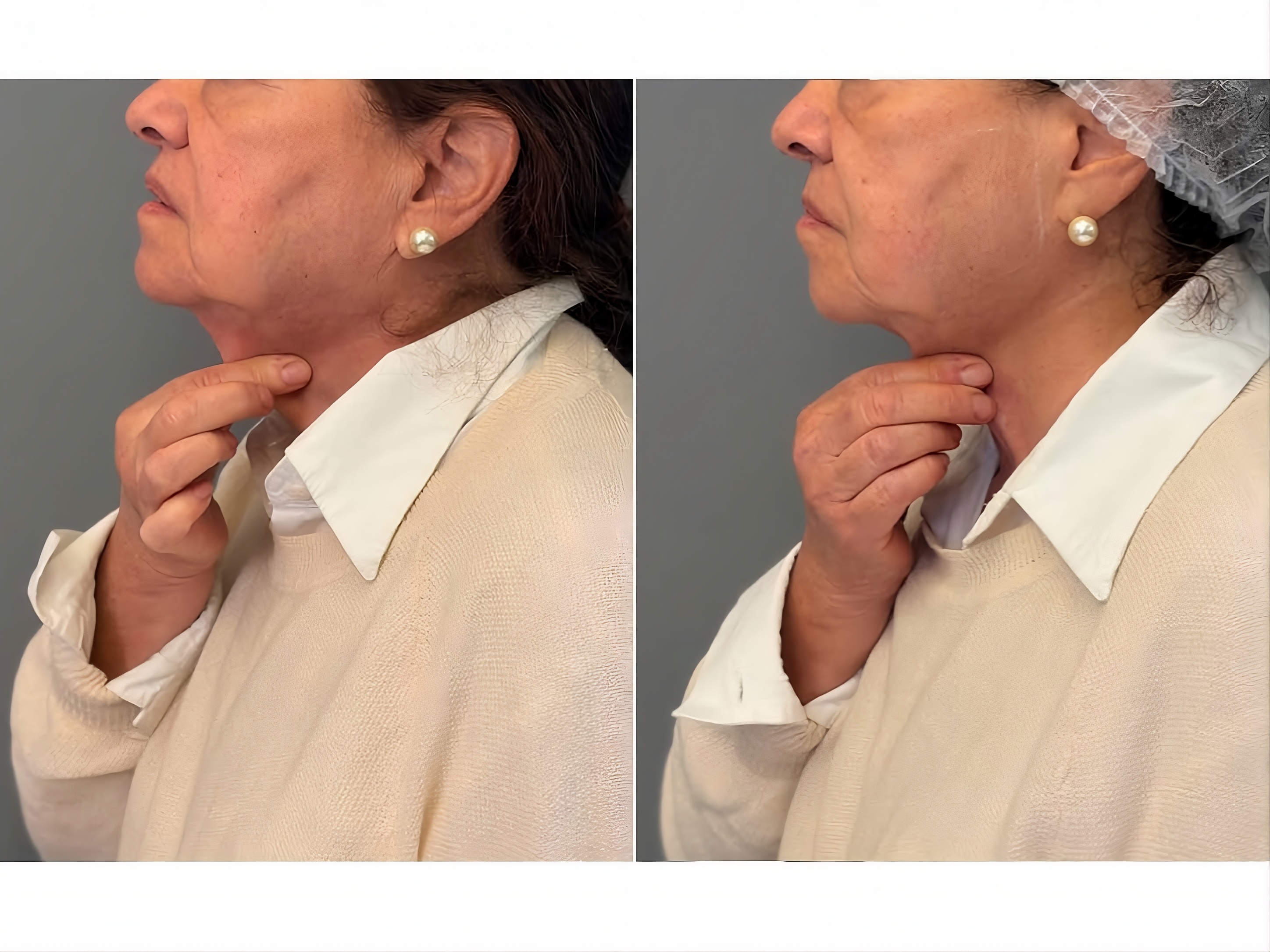 Antes e depois — papada