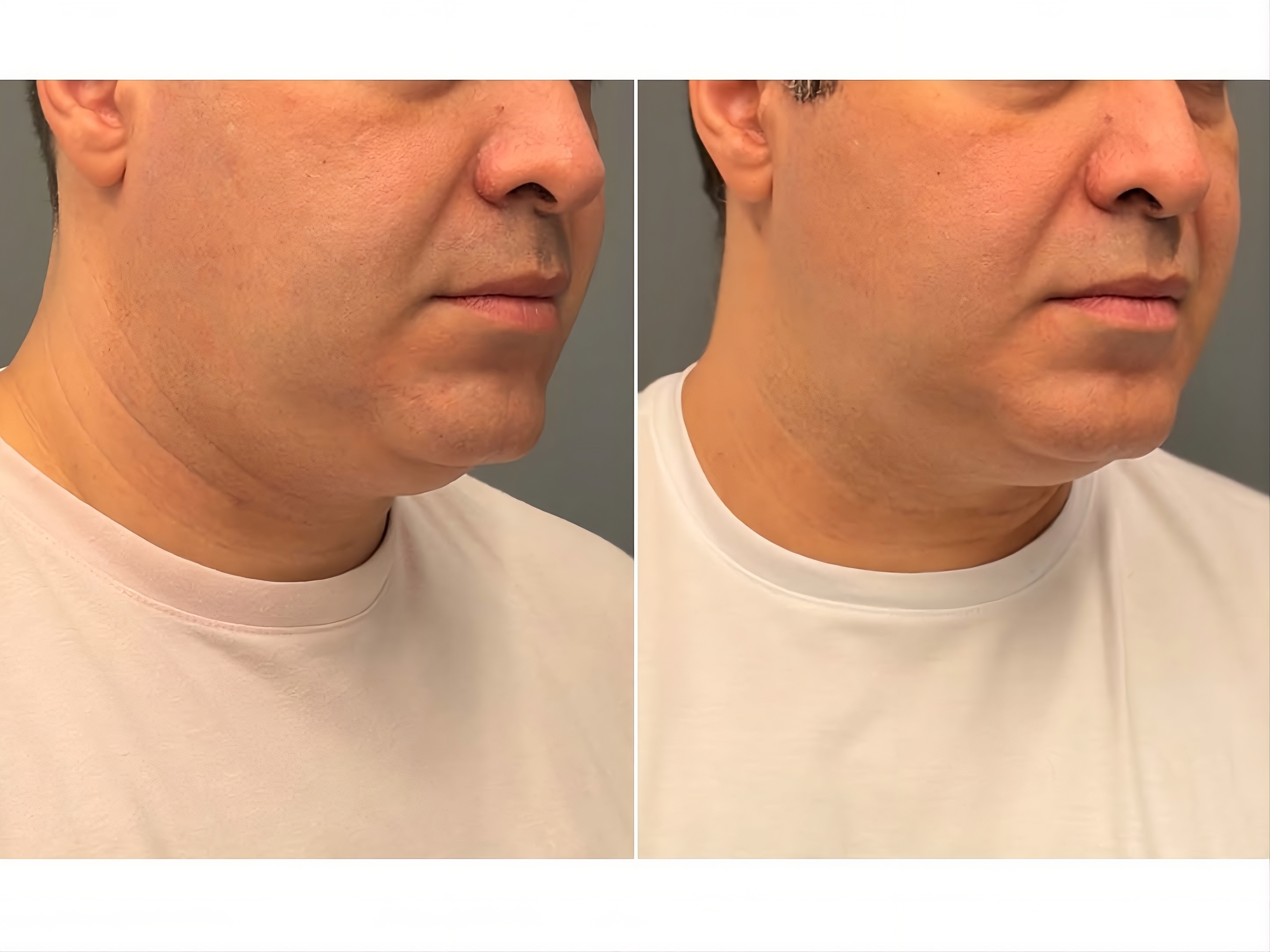 Antes e depois — pescoço