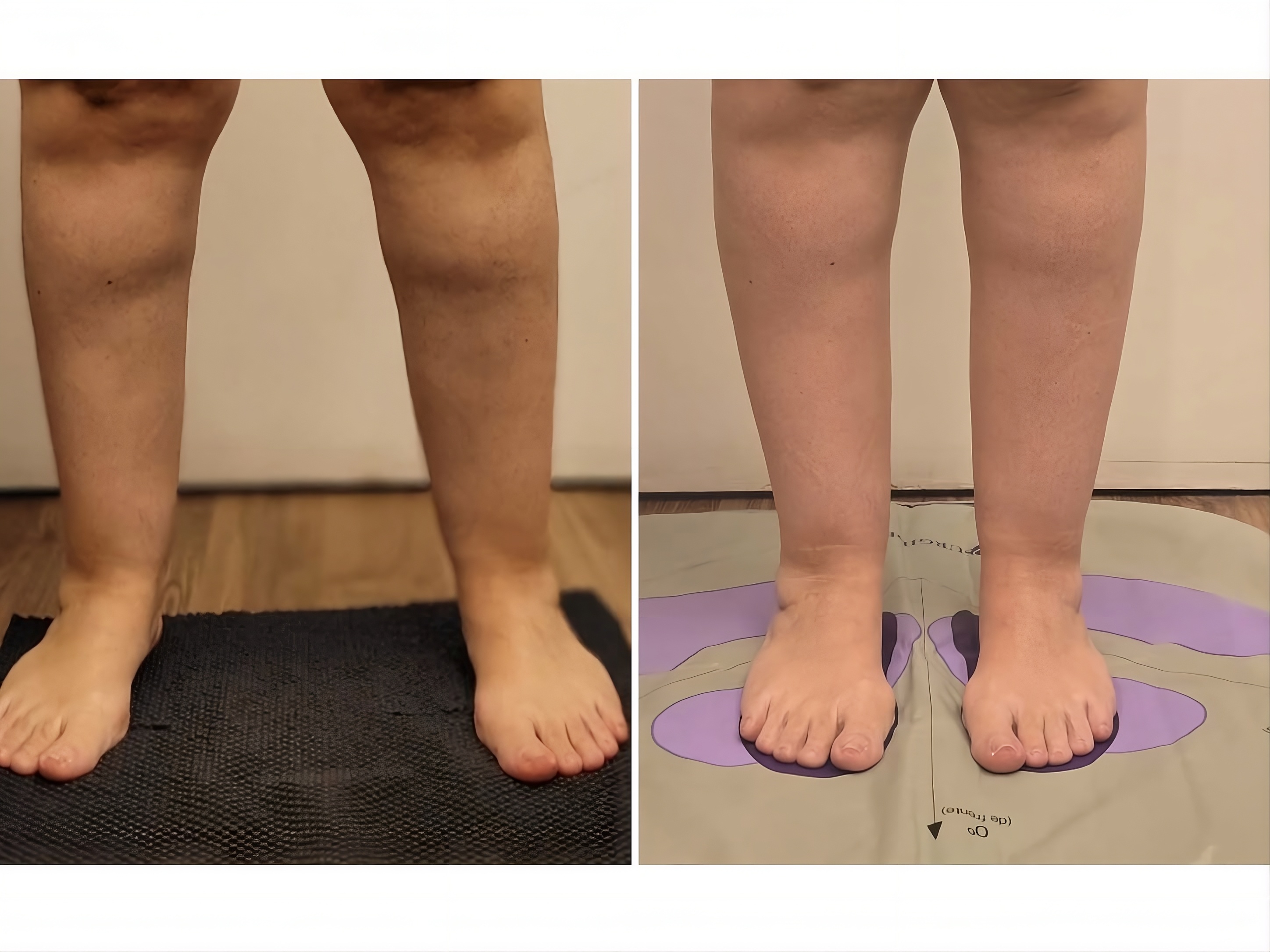 Antes e depois — gordura localizada abaixo dos joelhos